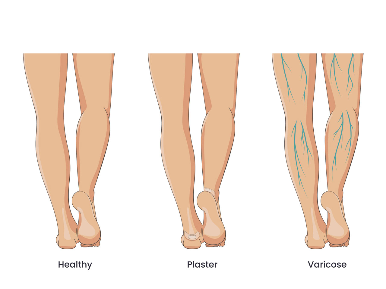 Foot clipart bare female legs healthy with strip bandage heels with varicose veins heel callus wound